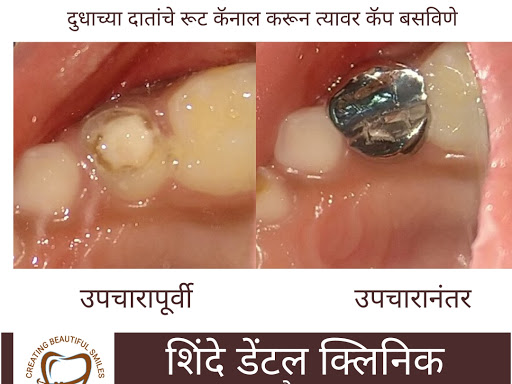 दंत उपचाराला न घाबरता आनंदाने उपचार करवून घेणारा गोड आनंदी पेशंट post image