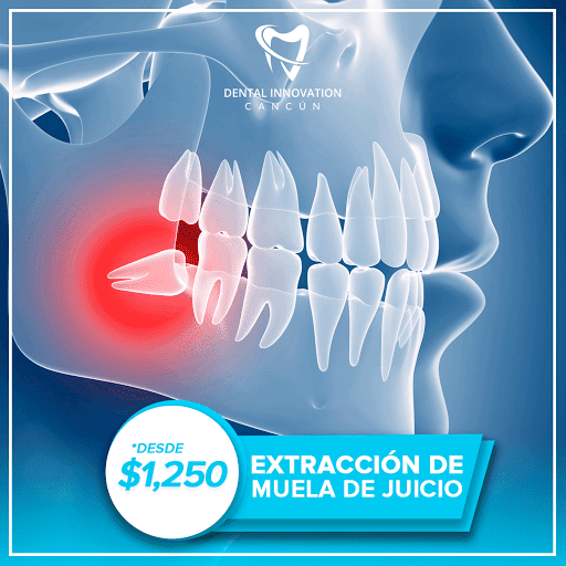 Dental Innovation Cancún - Tu Dentista en Cancún - Thumbnail
