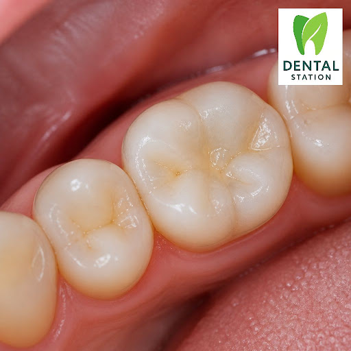 Worried that a cavity will spoil your smile? At Dental Station in Mehdipatnam, Hyderabad, we use… post image