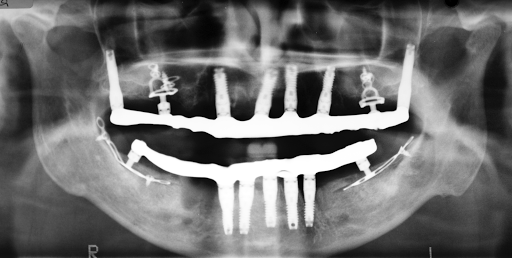 Dr Philippe Cotten / Clinica Cotten Implantes Dentales Barcelona - Thumbnail