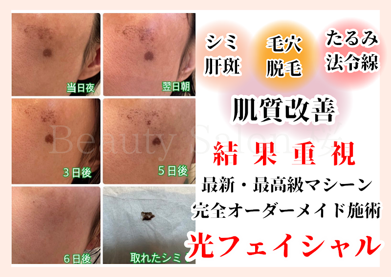 シミ・肝斑/毛穴/ニキビ/肌質改善/Beauty Salon 桜