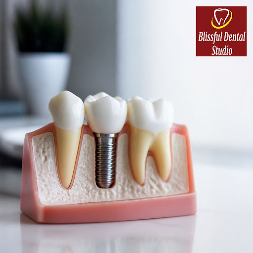 Dreaming of fixed teeth that look and feel natural? At Blissful Dental Studio Best dentist in Sec… post image