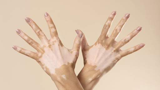 Vitiligo is a skin condition that causes patches of skin to lose their natural pigment due to the… post image
