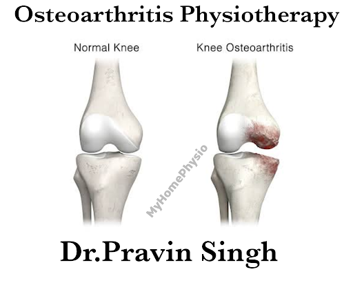 Osteoarthritis knee physiotherapy treatment  post image