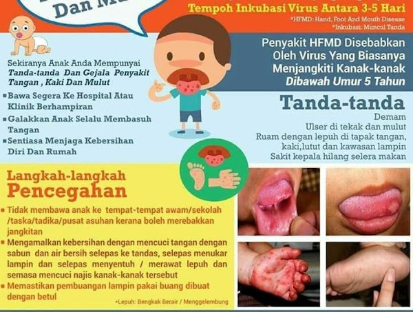 Mulut kanak kanak ulser Selain Bonjela,