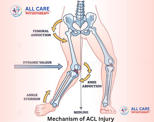 🏠 ACL Injury Treatment at Home – By All Care Physiotherapy 🦵