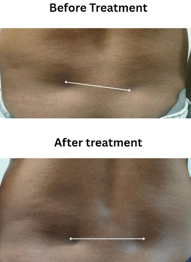 Fixing Pelvic malalignment