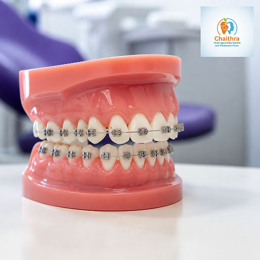 Notice gaps between your teeth affecting your smile or confidence? At Chaithra Multi Speciality D… post image