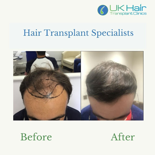 UK Hair Transplant Clinics Belfast - Thumbnail