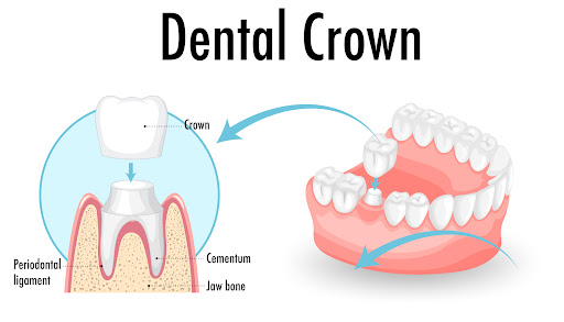 Treatment of Tooth Wear: Protecting Function and Smile