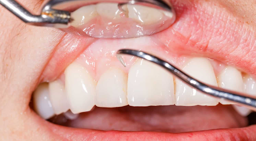 Bone loss is a common dental concern that can affect both the function and appearance of your tee…
