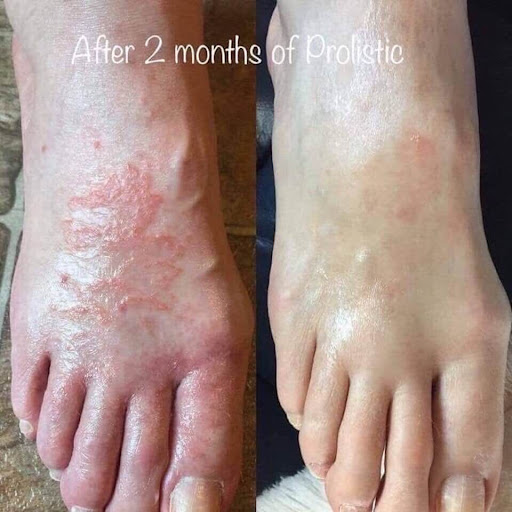 Struggling with eczema, psoriasis, or chronic skin inflammat