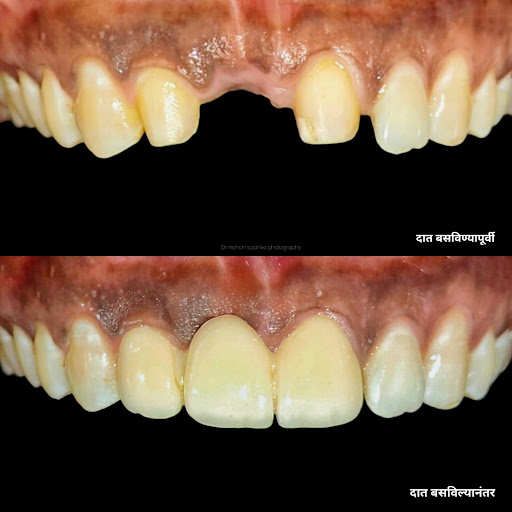 🦷 Dental Crowns – Before & After post image