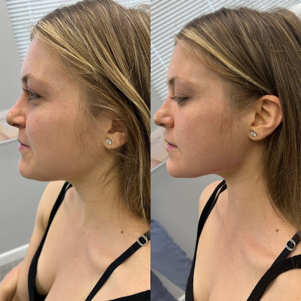 The Skin Tightening, Botox And Lip Fillers By Skinsation La Statements thumbnail