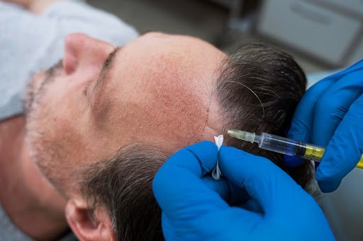 FUE hair transplant in Borivali Mumbai may be an option for gradual hair thinning.