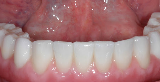 Dr Philippe Cotten / Clinica Cotten Implantes Dentales Barcelona - Thumbnail