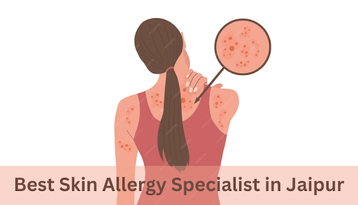 Suffering from skin allergies can be distressing, but finding the…