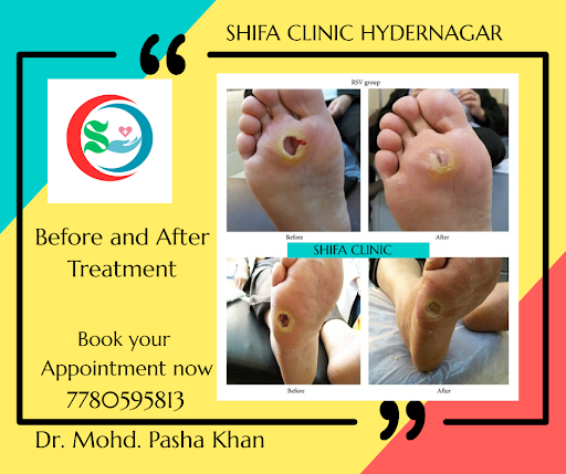 Shifa Clinic, Hydernagar is one of the best diabetic foot clinics in Hyderabad, specializing in a… post image
