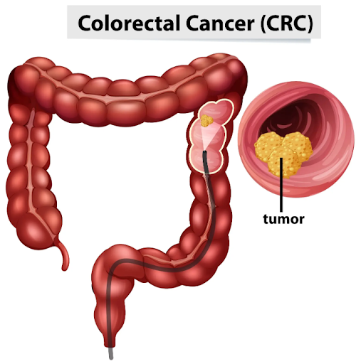 Colon and rectal cancer, also known as colorectal cancer, develops in the large intestine or rect…