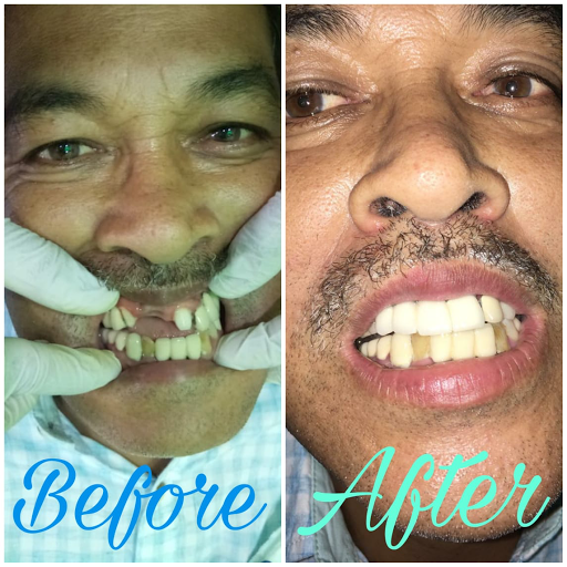 Replace your Missing teeths by Crown & Bridge... post image