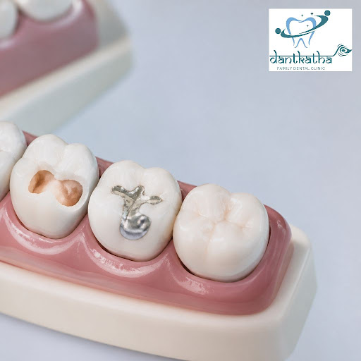 Worried about cavities or chipped teeth? At Dantkatha Family Dental Clinic in Shukrawar Peth, Pun…
