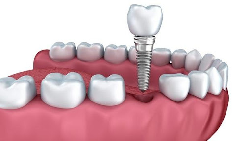 Clínica Dental Implantdent Empuriabrava - Thumbnail
