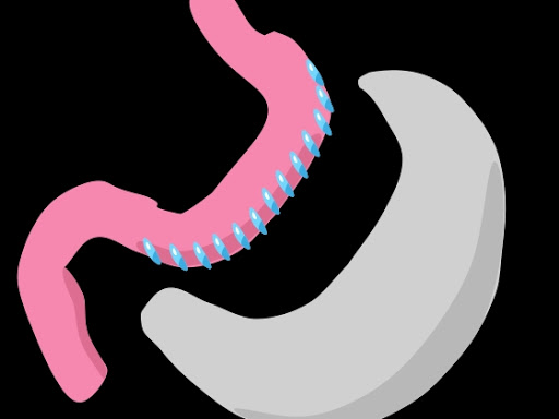 Bariatric surgery is a surgery done on morbidly obese patients who are significantly overweight a…