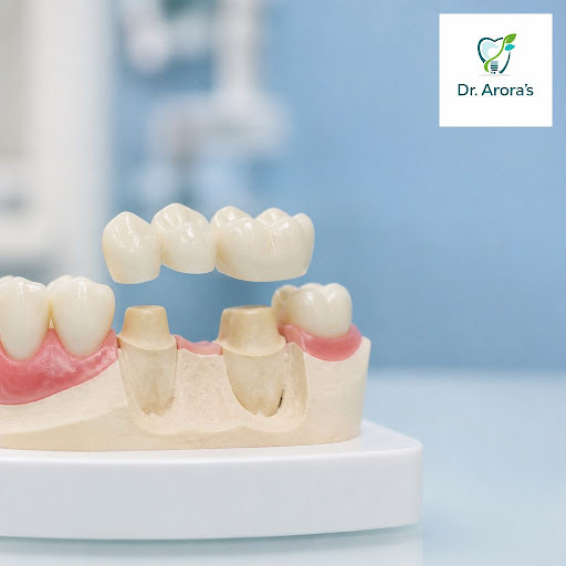 Missing teeth affecting your smile or chewing comfort? At Dr. Arora's Multispeciality Dental Clin… post image