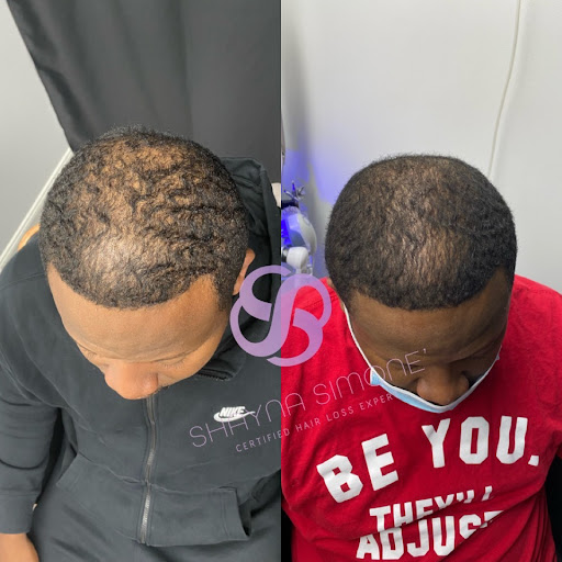 Shayna Simone', Certified Hair Loss Expert - Thumbnail