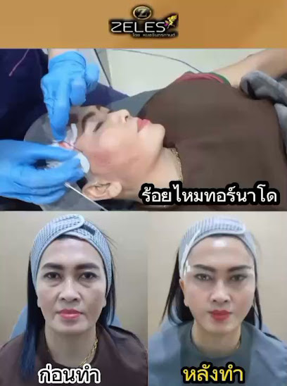 Zeles Clinic คลินิกความงามอุบล ร้อยไหม โบท็อก ฟิลเลอร์ รักษาสิวฝ้ากระ อุุบล