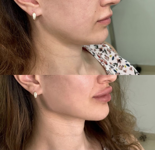 Brows Fillers Harrogate Medical Aesthetics - Thumbnail