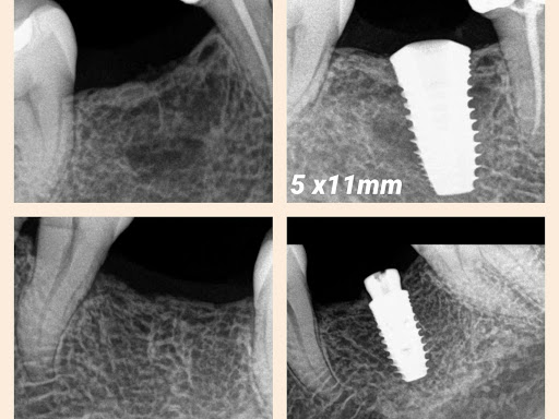 Dental Implants At Affordable Prices post image