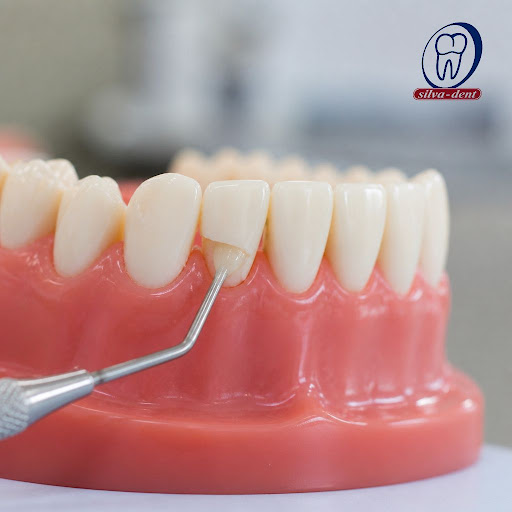 Chipped or cracked front teeth can affect both your smile and your confidence. At Silva Dent Mult… post image