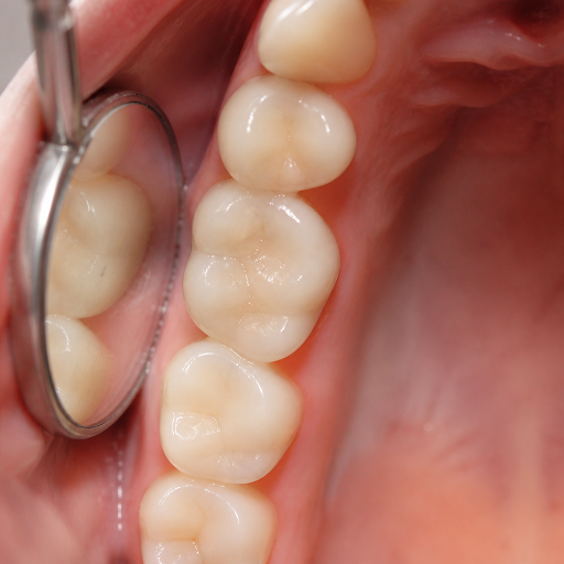Wondering how modern fillings can repair your teeth without spoiling your smile? At Agrawat Denta… post image