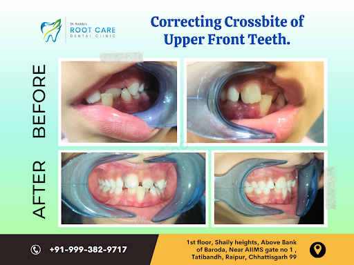 *If you are concerned about a crossbite, talk to our dentist about treatment options. They can he…