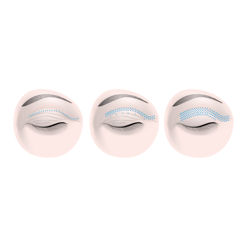 PERMANENT MAKE - UP | FIBROBLAST | Face Spezialistin Gina Funke Dresden - Thumbnail