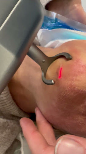 Epil Zoto laser - Schoonheidssalon