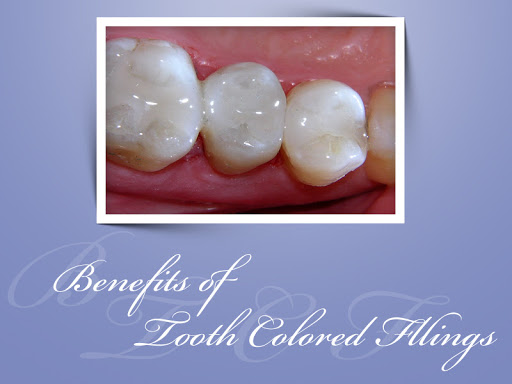 Benefits of #tooth #colored #filling: post image