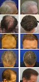 Hair transplant clinic Advanced Medical Hair Institute / Joseph L. Williams, Md in Las Vegas