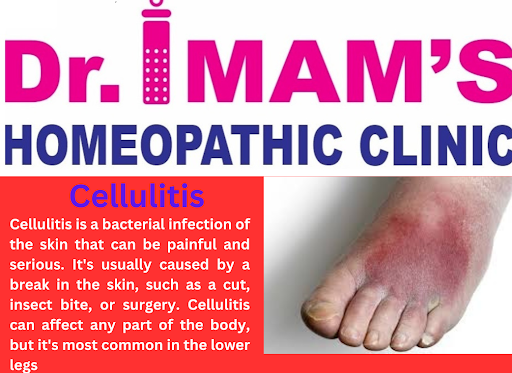 Homeopathy provides several remedies that beneficial in managing cellulitis, tailored to individu…