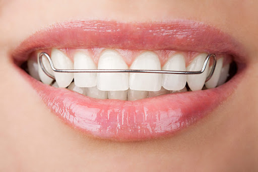 Choosing between a fixed retainer and a removable retainer is an important decision for maintaini… post image