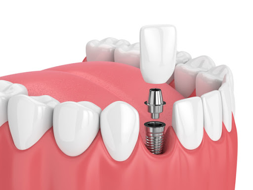 Happy Smiles Dentist Hornsby - Thumbnail
