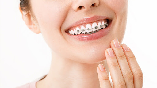 We provide a wide range of advanced orthodontic options including metal braces, ceramic braces, l… post image