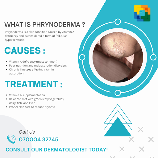Phrynoderma, also known as follicular hyperkeratosis, is a skin condition caused by vitamin A def…