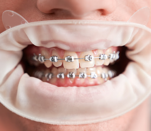 Thinking about straightening your teeth or improving your smile? At Cureway Smile Studio, we prov… post image