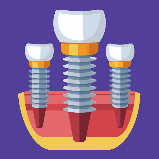 Implant-supported dentures are dentures that are secured using dental implants placed in the jaw.… post image