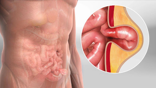 A hernia occurs when an internal organ or tissue pushes through a weak area in the muscle wall, c… post image