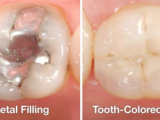 Tooth-Colored Fillings. ... Tooth-colored fillings are made of a blend, or “composite,” of plasti…