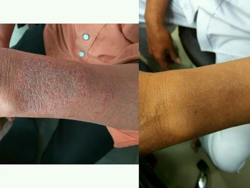 Skin allergy ? Are you suffer from skin allergy.intolerable itching ? Than why are you waiting ?h… post image