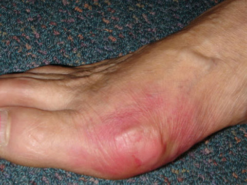 Gout homeopathic treatment post image
